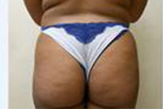 Brazilian Butt Lift Before & After Patient #1179
