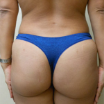 Brazilian Butt Lift Before & After Patient #1181