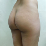 Brazilian Butt Lift Before & After Patient #1183