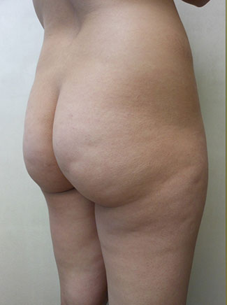 Brazilian Butt Lift Before & After Patient #1184