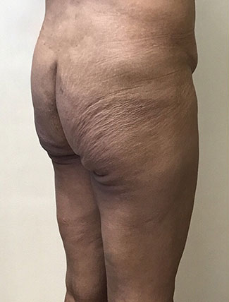 Brazilian Butt Lift Before & After Patient #1188