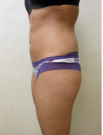 Brazilian Butt Lift Before & After Patient #1224