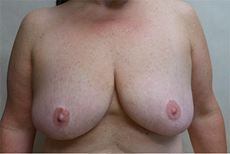 Breast Lift Before & After Patient #431