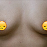 Breast Augmentation Before & After Patient #367