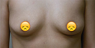 Breast Augmentation Before & After Patient #367