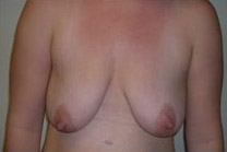 Breast Lift With Augmentation Before & After Patient #460