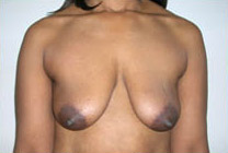 Breast Lift With Augmentation Before & After Patient #500
