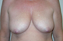 Breast Lift With Augmentation Before & After Patient #502