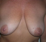 Breast Lift With Augmentation Before & After Patient #503