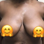 Breast Reduction Before & After Patient #532