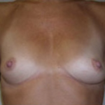 Breast Augmentation Before & After Patient #369