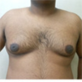 Gynecomastia Before & After Patient #549