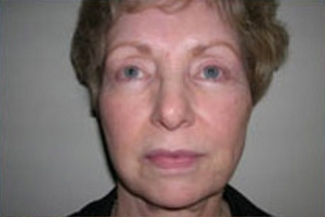 Face Lift Before & After Patient #632
