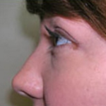 Rhinoplasty Before & After Patient #669