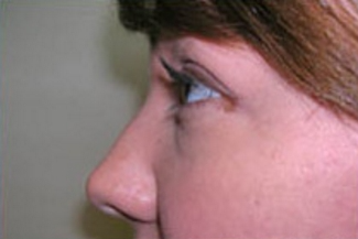 Rhinoplasty Before & After Patient #669