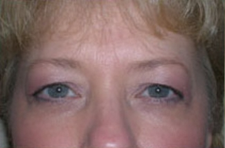 Blepharoplasty Before & After Patient #703