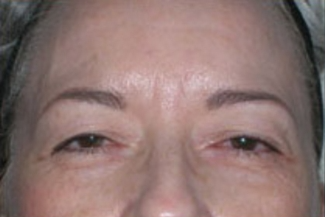 Blepharoplasty Before & After Patient #704