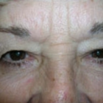 Blepharoplasty Before & After Patient #705