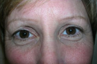 Blepharoplasty Before & After Patient #707