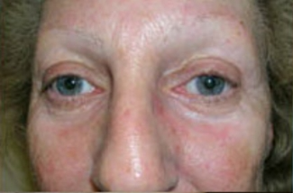 Blepharoplasty Before & After Patient #734