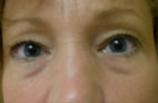 Blepharoplasty Before & After Patient #736