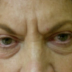Browlift Before & After Patient #769