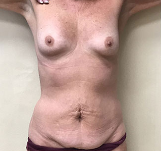 Abdominoplasty Before & After Patient #778