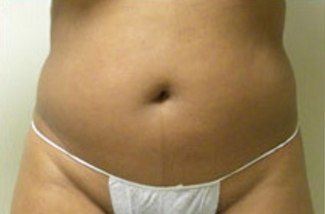 Abdominoplasty Before & After Patient #779