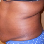 Abdominoplasty Before & After Patient #782