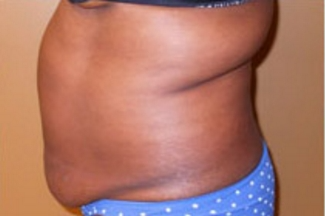 Abdominoplasty Before & After Patient #782