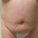 Abdominoplasty Before & After Patient #785