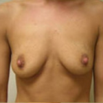 Breast Augmentation Before & After Patient #373