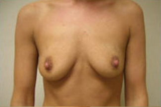 Breast Augmentation Before & After Patient #373