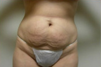 Abdominoplasty Before & After Patient #841