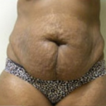 Abdominoplasty Before & After Patient #842