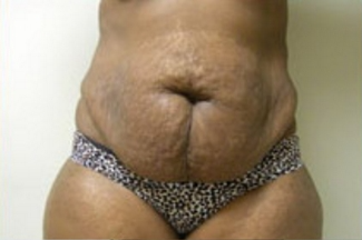 Abdominoplasty Before & After Patient #842