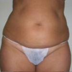 Abdominoplasty Before & After Patient #843