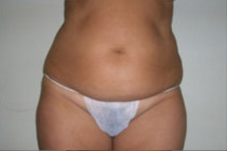 Abdominoplasty Before & After Patient #843