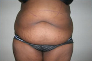 Abdominoplasty Before & After Patient #845