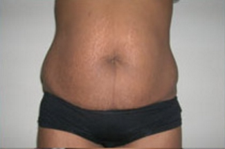 Abdominoplasty Before & After Patient #846