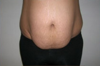 Abdominoplasty Before & After Patient #848