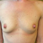 Breast Augmentation Before & After Patient #374
