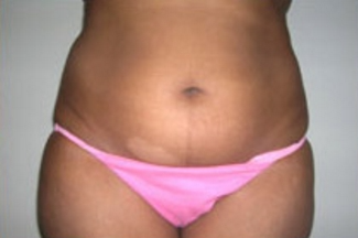 Abdominoplasty Before & After Patient #892
