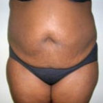 Abdominoplasty Before & After Patient #894