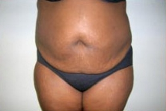 Abdominoplasty Before & After Patient #894