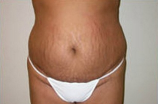 Abdominoplasty Before & After Patient #895