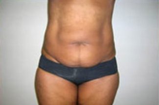 Abdominoplasty Before & After Patient #896