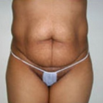 Abdominoplasty Before & After Patient #897