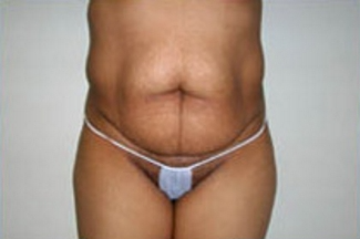 Abdominoplasty Before & After Patient #897