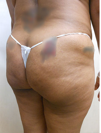 Brazilian Butt Lift Before & After Patient #1222